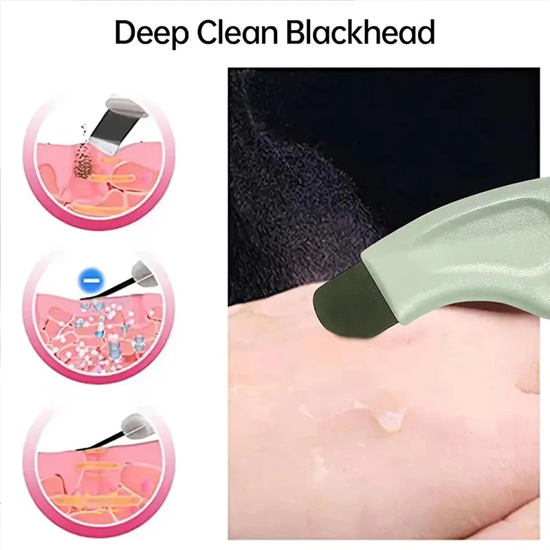 Deep Cleansing Blackhead & Whitehead Removal Tool