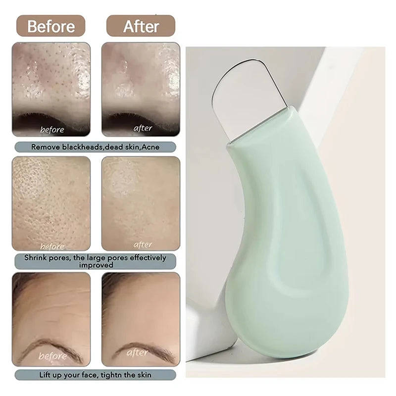 Deep Cleansing Blackhead & Whitehead Removal Tool
